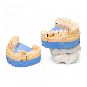 Металлокерамические коронки
